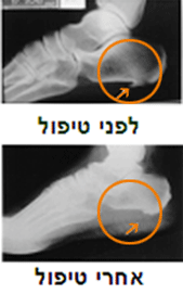 2 תמונות רנטגן של עצם העקב שמציגות את השפעת הטיפול בבעית הדורבן בעקב ופירור ההיסתיידות