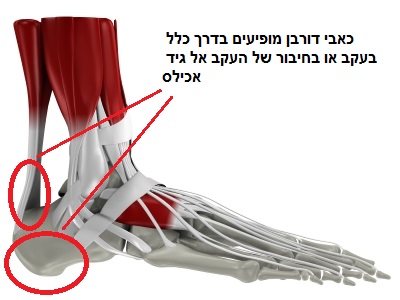 תרשים של הנקודות בהן עלולים להתפתח כאבי דורבן